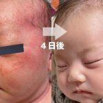 乳児湿疹は悩まずこれで4日で解決！現在1歳6か月の息子のお肌は透き通った白い肌に