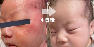 乳児湿疹は悩まずこれで4日で解決！現在1歳6か月の息子のお肌は透き通った白い肌に